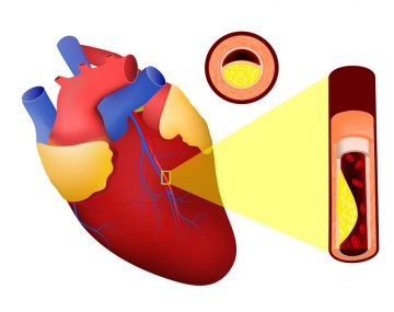 Imagem ilustrativa de um infarto agudo do miocárdio