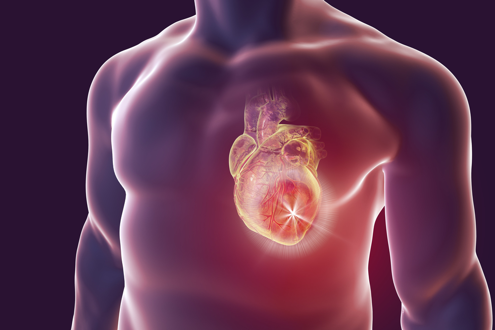 Enfarte agudo do miocárdio ou Ataque Cardíaco (coração)